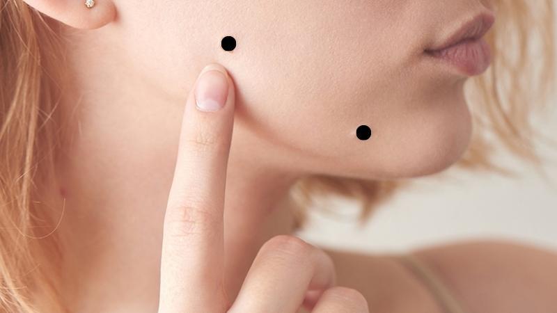 Tư vấn về việc xóa nốt ruồi tử vi an toàn